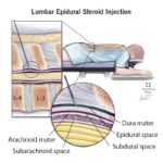 Dự án tối ưu chẩn đoán và điều trị đau thắt lưng đa mô thức