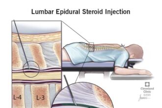 Dự án tối ưu chẩn đoán và điều trị đau thắt lưng đa mô thức
