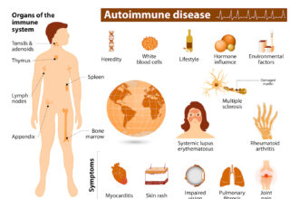 Bệnh tự miễn có chữa khỏi được không?