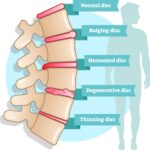 Kinh nghiệm tối ưu điều trị đau thắt lưng, đau cổ vai gáy, hội chứng ống cổ tay, thoái hóa khớp gối, thoái hóa cột sống